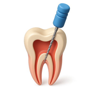 3D Icon of a Dental Root Canal Procedure