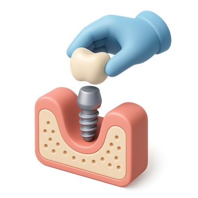 3D Dental Implant Placement Icon for Healthcare